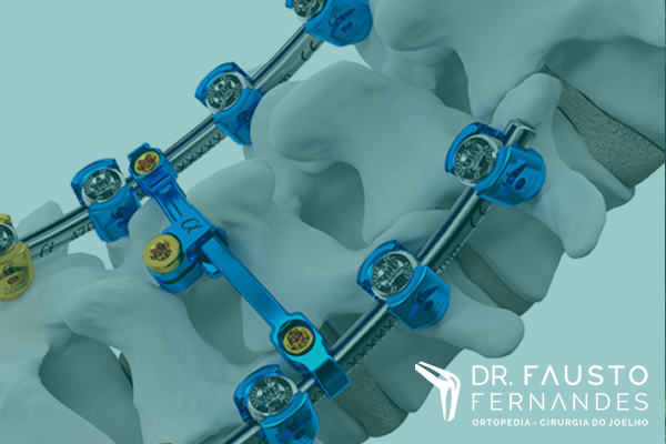 Osteossíntese: técnicas e evolução tecnológica