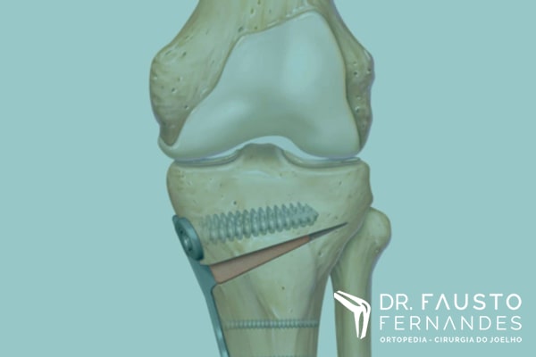 Osteotomias de membro inferior